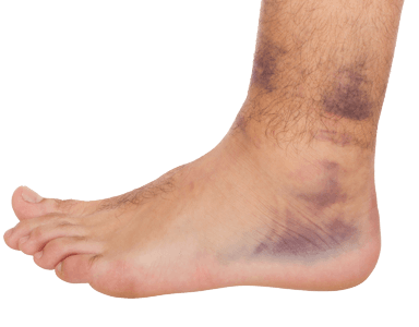 Ankle Sprain / Strain