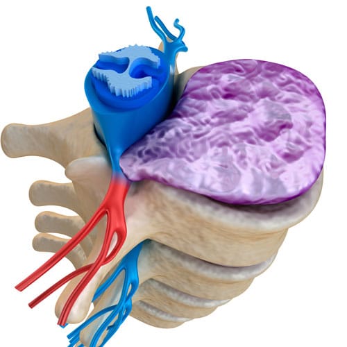 Bulging & Slipped Disc