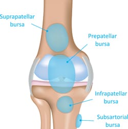 Bursitis