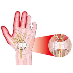 Carpal Tunnel Syndrome