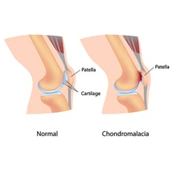 Chondromalacia (Runner's Knee)