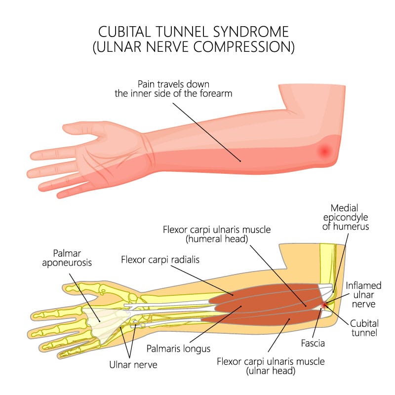 Cubital Tunnel Syndrome