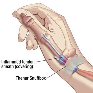 DeQuervain's Tenosynovitis