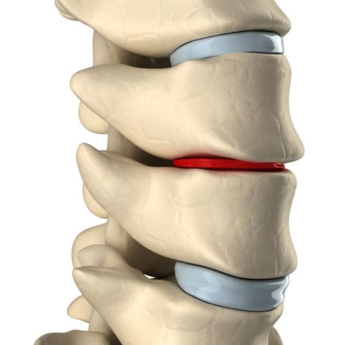Degenerative Disc Disease (DDD)