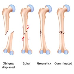 Knee Fracture