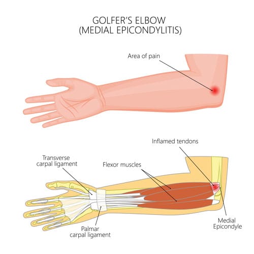 Medial Epicondylitis (Golfer's Elbow)