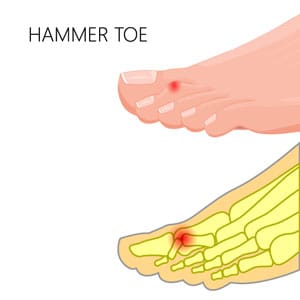 Hammer | Claw | Toe Deformities