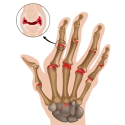 Wrist & Hand & Thumb Arthritis