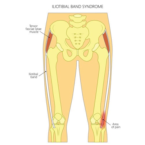 Iliotibial Band (Friction) Syndrome