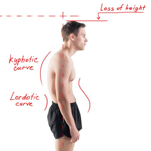 Kyphosis | Dowager's Hump