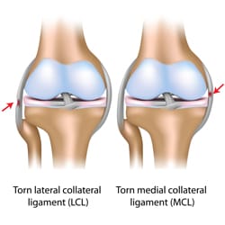 MCL & LCL Sprain & Tear