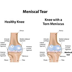 Meniscus Injury