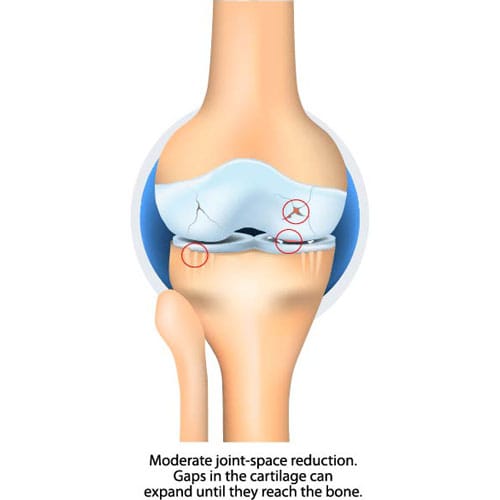 Moderate OA Knee Braces