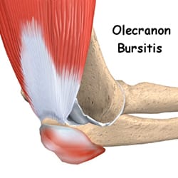 Olecranon Bursitis