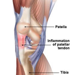 Patellar Tendonitis and Tendonosis (Jumper's Knee)