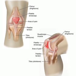 Patellofemoral Pain Syndrome (Runner's Knee)