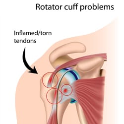 Rotator Cuff Sprain, Strain and Tears