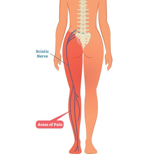 Sciatica