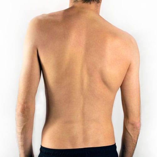 Scoliosis