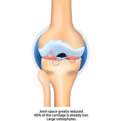 Severe OA Knee Braces