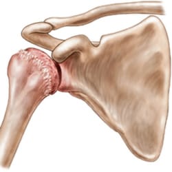 Shoulder Arthritis