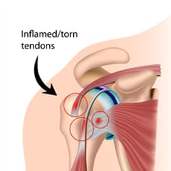 Shoulder Impingement Syndrome