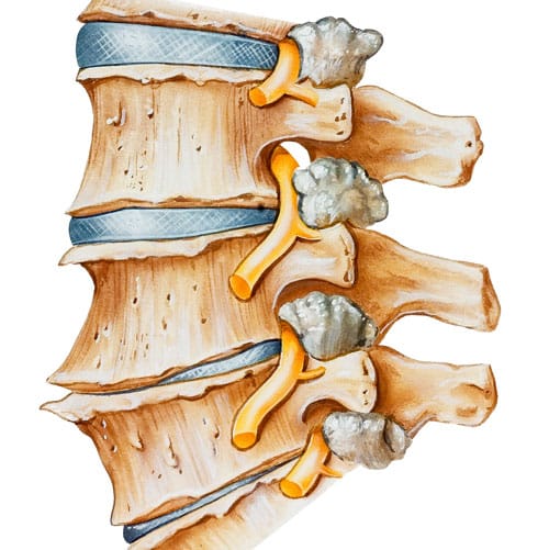 Lower Back Arthritis