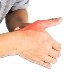 Thumb Sprain