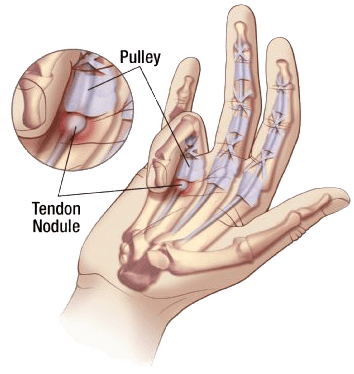 Trigger Finger