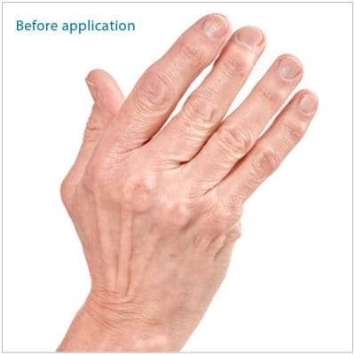 3PP Polycentric Hinged Ulnar Deviation Splint - Image 4