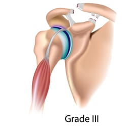 Separated Shoulder (AC Joint Separation)