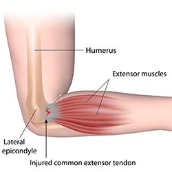 Lateral Epicondylitis (Tennis Elbow)