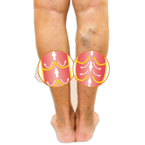 Deep Vein Thrombosis (DVT) risk factors and prevention after surgery