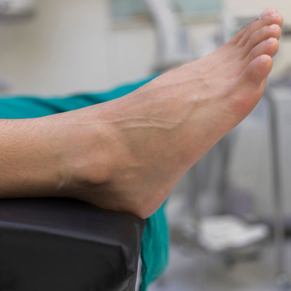 Foot Drop | Peroneal Nerve Injury