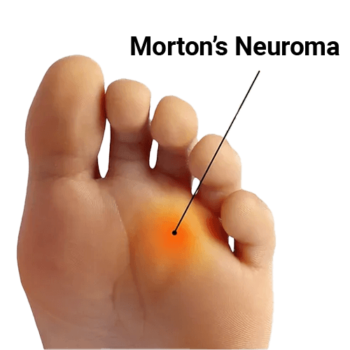 Morton's Neuroma