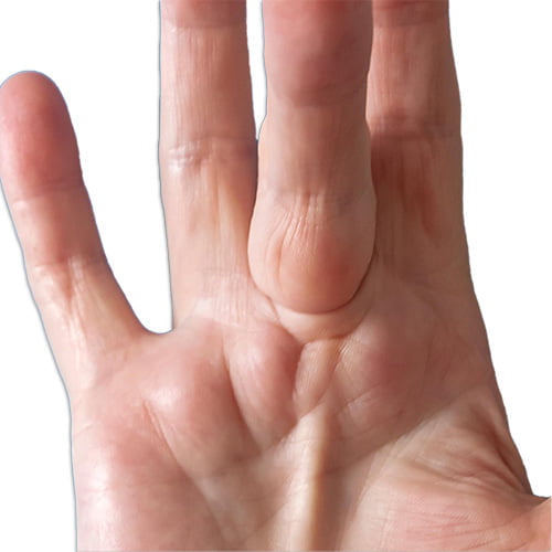Dupuytren's Contracture Syndrome