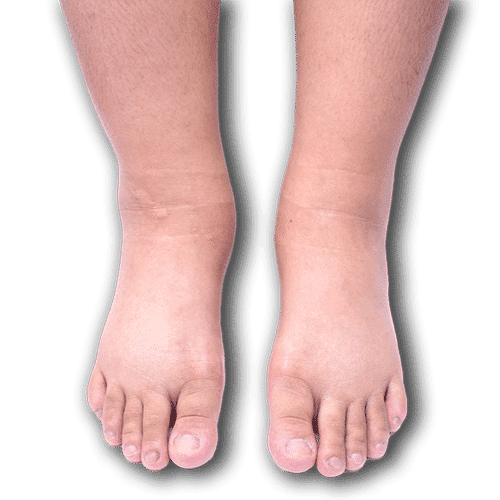 Lymphedema