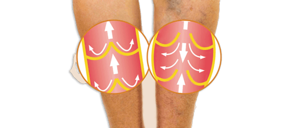 Deep Vein Thrombosis (DVT) risk factors and prevention after surgery